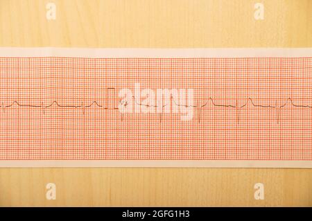 EKG-Testergebnisse auf Millimeterpapier, Herzrhythmus-Ergebnisse, Nahaufnahme der EKG-Diagrammdetails Stockfoto