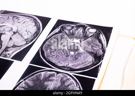 MRT-Bild des Gehirns auf Papier Nahaufnahme Stockfoto