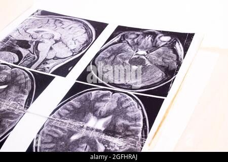 MRT-Bild des Gehirns auf Papier Nahaufnahme Stockfoto