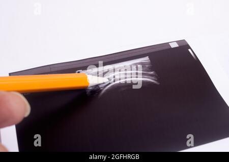 Muskelrisse im Ultraschallbild aus der Nähe Stockfoto