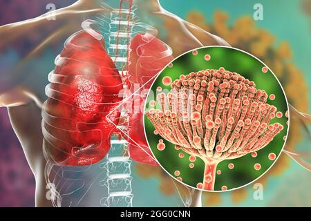 Illustration einer pulmonalen Aspergillose, Invasion eines Lungengewebes durch Schimmelpilze Aspergillus mit Nahaufnahme der Pilze. Stockfoto