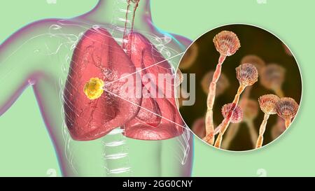 Illustration einer pulmonalen Aspergillose, Invasion eines Lungengewebes durch Schimmelpilze Aspergillus mit Nahaufnahme der Pilze. Stockfoto