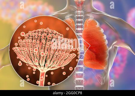 Illustration einer pulmonalen Aspergillose, Invasion eines Lungengewebes durch Schimmelpilze Aspergillus mit Nahaufnahme der Pilze. Stockfoto