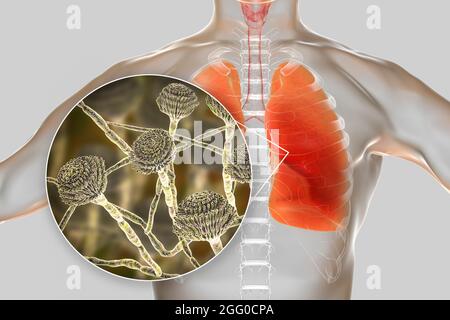 Illustration einer pulmonalen Aspergillose, Invasion eines Lungengewebes durch Schimmelpilze Aspergillus mit Nahaufnahme der Pilze. Stockfoto