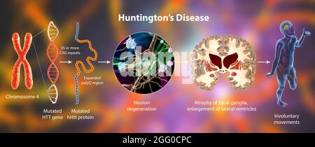 Molekulare Genese der Huntington-Krankheit, Illustration. Die Erweiterung der CAG-Trinukleotid-Sequenz im htt-Gen verursacht die Produktion eines mutierten Huntingtin-Proteins, das zu Neurodegeneration, Atrophie der Hirnganglien, unfreiwilligen Bewegungen und Demenz führt. Stockfoto