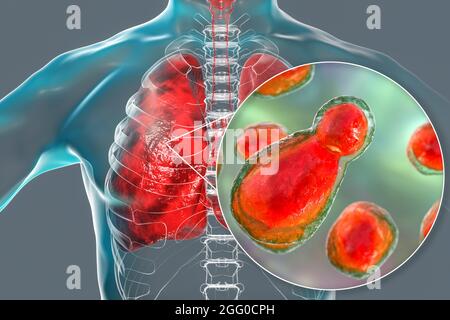 Illustration der pulmonalen Kryptokokkose, Invasion eines Lungengewebes durch Hefepilze Cryptococcus neoformans mit Nahaufnahme der Pilze. Stockfoto