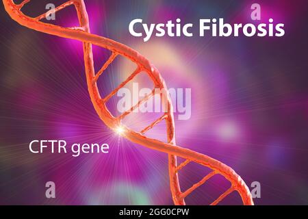 Illustration der zystischen Fibrose, einer erblichen Erkrankung (auch Mukoviszidose genannt) führt dazu, dass die Atemwege (Bronchien) mit Schleim verstopft sind, was zu schwerer Atemnot führt. Stockfoto