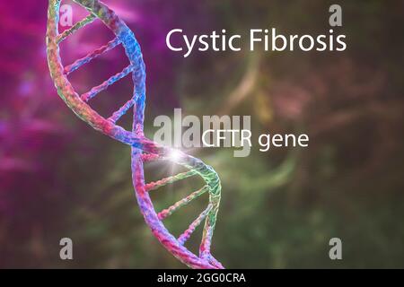 Illustration der zystischen Fibrose, einer erblichen Erkrankung (auch Mukoviszidose genannt) führt dazu, dass die Atemwege (Bronchien) mit Schleim verstopft sind, was zu schwerer Atemnot führt. Stockfoto