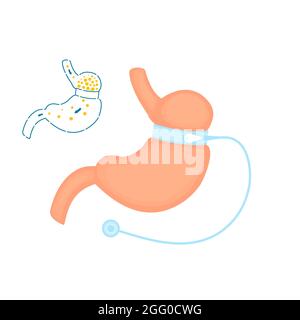 Verstellbare bariatrische Operation mit Magenband, Abbildung. Stockfoto