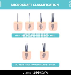 Haarmikrotransplantations-Klassifizierungsset für Haartransplantations-Operationen, konzeptionelle Illustration. Stockfoto