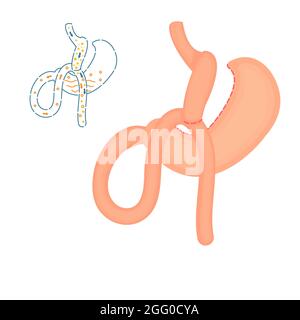 Mini-Magenbypass-Adipositaschirurgie, Illustration. Stockfoto