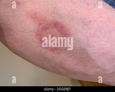 Bullseye Ausschlag auf Unterschenkel, Zeichen der Lyme-Borreliose. Neun Tage nach dem Biss. Nach fünf Tagen antibiotischer Behandlung verblassen die Farben. Stockfoto