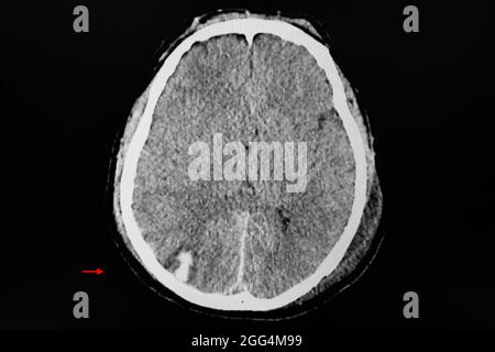 CT-Gehirn eines Patienten mit einer Kopfverletzung, die eine hämorrhagische Konusion am rechten Hinterhauptlappen zeigt. Stockfoto