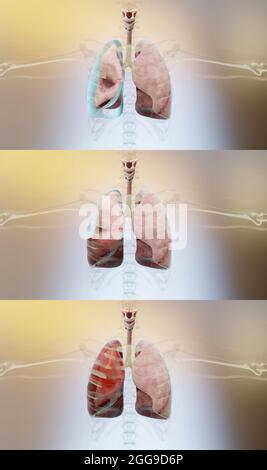 3d-Illustration von Pneumothorax, Hemothorax und Hemopneumothorax, normale Lunge versus kollabiert, Symptome von Pneumothorax, Pleuraerguss, Empyema, 3 Stockfoto