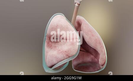3d-Darstellung des Pneumothorax, normale Lunge versus kollabiert, Symptome des Pneumothorax, Pleuraerguss, Empyema, Komplikationen nach einer Brustverletzung Stockfoto