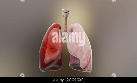 3d-Darstellung von Hämothorax, normale Lunge versus kollabiert, Symptome von Hämothorax, Pleuraerguss, Empyema, Komplikationen nach einer Brustverletzung, Stockfoto