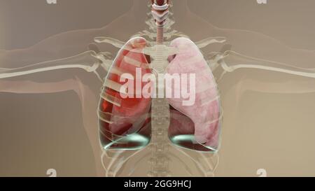 3d-Darstellung von Hämothorax, normale Lunge versus kollabiert, Symptome von Hämothorax, Pleuraerguss, Empyema, Komplikationen nach einer Brustverletzung, Stockfoto