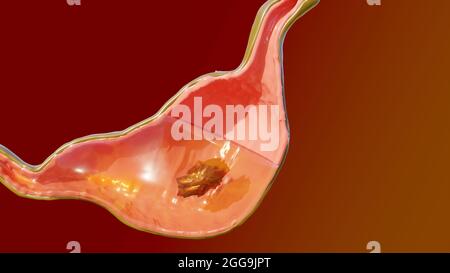 3d-Illustration der Anatomie des menschlichen Magens Verdauung, 3D-Reibe Stockfoto