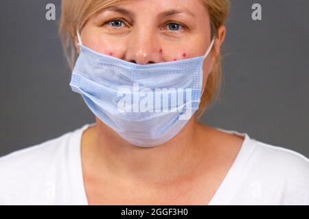 Nahaufnahme Foto einer blonden Frau in einer medizinischen Gesichtsmaske mit Akne-Problem nach dem Tragen dieser Einweg-Maske eine lange Zeit. Stockfoto