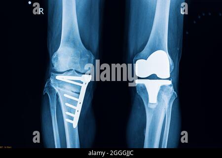 Röntgenfilm eines Patienten nach totaler Operation am linken Knie und Fixierung der gebrochenen rechten Tibia durch Platten und Schrauben. TKA-Operation und knieprost Stockfoto