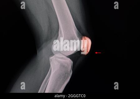 Knieröntgenaufnahme eines Patienten mit einer klaren Linie am unteren Teil der Patella mit linearer, nicht verdrängter Fraktur der Patella und linkem Knieerguss. Stockfoto