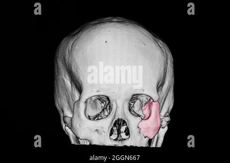 3-D-Nachderfilm eines Schädels eines Patienten mit traumatischer Hirnverletzung, der einen gebrochenen zygomatischen Knochen zeigt (rosa Bereich) Stockfoto