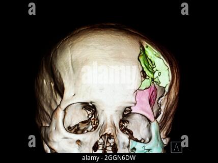 3 D-Darstellung eines Schädels eines Patienten mit traumatischer Hirnverletzung, der schwere Depressionsfrakturen von linkem temporoparietalen, supraorbitalen und Zygom zeigt Stockfoto