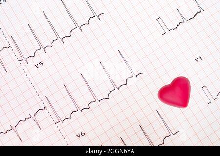 Ein abnormes EKG-Tracing (laterale Wand-Ischämie) und ein rotes herzförmiges Objekt, Herzkrankheitskonzept, medizinischer Hintergrund, Stockfoto