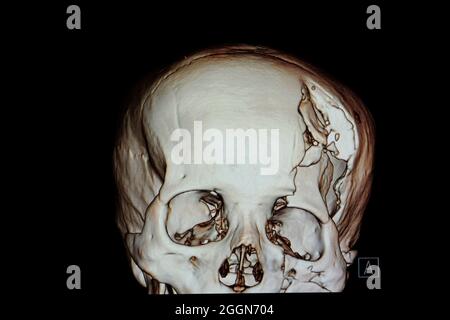 3-D-Darstellung eines Schädels eines Patienten mit traumatischer Hirnverletzung, die eine Kompressionsfraktur des linken temperoparietalen Knochens und eine Fraktur des linken Orbitales zeigt Stockfoto