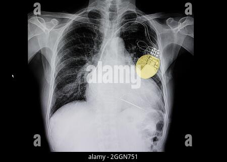 Thorax-Röntgenfilm eines Patienten mit Kardiomegalie und eines Herzschrittmachers, der in seiner Brust gelb hervorgehoben ist. Stockfoto