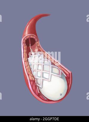 Medizinische Illustration mit Ballonangioplastie und Einfügung von Dentstieren. Stockfoto