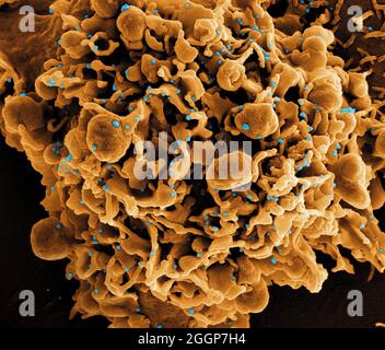 Eingefärbtes Rasterelektronenmikrograph einer Zelle (braun), die mit SARS-CoV-2-Viruspartikeln (blau) infiziert ist und aus einer Patientenprobe isoliert wurde. Stockfoto