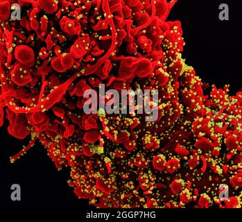 Koloriertes Rasterelektronenmikrograph einer Zelle (rot) mit morphologischen Anzeichen einer Apoptose, infiziert mit SARS-COV-2-Viruspartikeln (gelb), isoliert aus einer Patientenprobe. Stockfoto