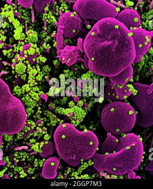 Eingefärbtes Rasterelektronenmikrograph einer apoptotischen Zelle (rosa), die stark mit SARS-CoV-2-Viruspartikeln (grün) infiziert ist und aus einer Patientenprobe isoliert wurde. Stockfoto