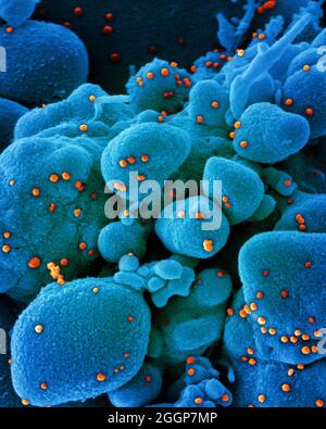 Eingefärbtes Rasterelektronenmikrograph einer apoptotischen Zelle (blau), die mit SARS-COV-2-Viruspartikeln (orange) infiziert ist und aus einer Patientenprobe isoliert wurde. Stockfoto