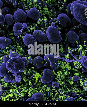 Eingefärbtes Rasterelektronenmikrograph einer apoptotischen Zelle (violett), die stark mit SARS-CoV-2-Viruspartikeln (grün) infiziert ist und aus einer Patientenprobe isoliert wurde. Stockfoto