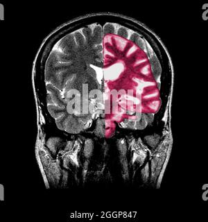 Ein zusammengesetztes Bild, das ein normales koronales (frontales) Querschnitt-MRT-Bild des Gehirns (in Graustufen) mit einem überlagerten koronalen MRT-Bild eines Gehirns mit fortgeschrittener Alzheimer-Erkrankung (in Pink) zeigt. Das erkrankte Gehirn zeigt eine schwere generalisierte Atrophie (Schrumpfung) des Hirngewebes mit einem akzentuierten Gewebeverlust, der die Temporallappen umfasst. Stockfoto