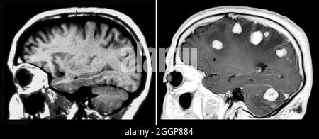 Auf der linken Seite befindet sich ein sagittales (von der Seite) T1 gewichtetes MRT, das die normale Anatomie des Gehirns zeigt. Rechts ist ein MRT eines Gehirns mit mehreren bösartigen Tumoren zu sehen. Diese Tumorknochen sind von einer ausgedehnten Schwellung umgeben (als die dunklen Bereiche gesehen). Stockfoto