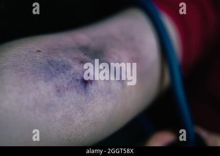 Der Arm der Frau ist durch die Einnahme von intravenösem Betäubungsmittel verletzt. Drogenabhängiger zieht das Tourniquet am Arm. Nahaufnahme des großen Bluthämatoms. Konzept von Verzweiflung und Depression. Sucht nach illegalen Substanzen. Stockfoto