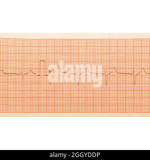 EKG-Testergebnisse auf Millimeterpapier, Herzrhythmus-Ergebnisse, Nahaufnahme der EKG-Diagrammdetails Stockfoto