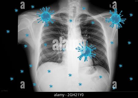 Visuelle Illustration einer Infektion mit dem Coronavirus (Covid-19) in der Lunge mit 3D-gerenderten Viruspartikeln und einem Röntgenfilm eines Patienten mit Right-lo Stockfoto