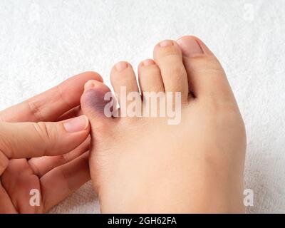 Frau Hand berührt kleinen Zeh mit lila Prellung nach Hausunfall. Blick auf den zerquetschten, rosafarbigen Zeh des weiblichen Fußes. Fußverletzung mit kleinen Fingern. Stockfoto