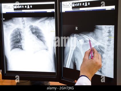 Ein Arzt überprüft Röntgenbilder auf einer großen Computer-Workstation mit Doppelbildschirmanzeige. Der Patient hat eine traumatische Fraktur des rechten Schlüsselbeins und des rechten Schlüsselbeins Stockfoto