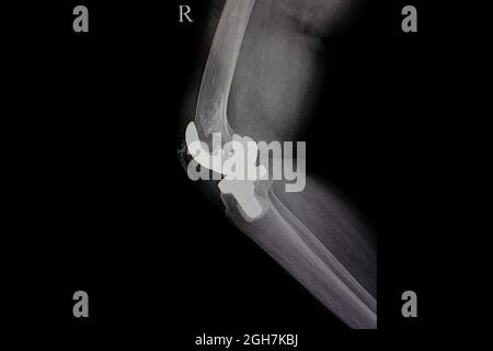 Röntgenfilm des menschlichen Knies mit Titan-Knieprothese Stockfoto