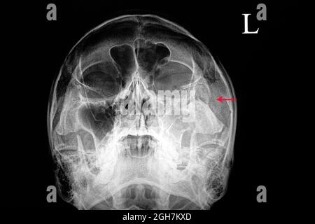 röntgenfilm eines Schädels eines Patienten mit traumatischer Verletzung, der einen gebrochenen linken Jochbein und eine traumatische Sinusitis zeigt Stockfoto