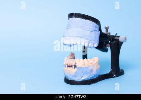 Zahnwiederherstellung mit Implantat. Gipsmodell der Zähne. Ober- und Unterkiefer Gipsmodell mit vorbereiteten Zähnen. Weiße Veneers der Vorderzähne bei der Diagnose Stockfoto