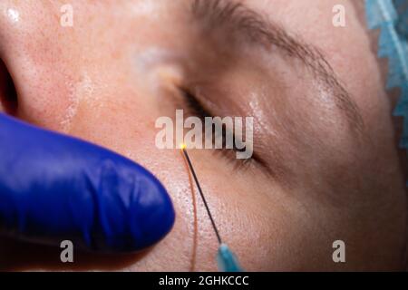 Doktor Kosmetologe macht biorevitalisierung Beauty-Injektionen in die Augenpartie zu nähren und befeuchten die Haut. Nahaufnahme Stockfoto