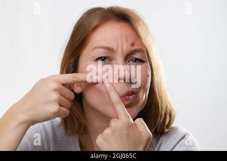 Medizin und Kosmetologie, Akne. Porträt einer jungen blonden Frau mit Pickel im Gesicht, drückt mit den Fingern einen Abszess aus. Weißer Hintergrund. Stockfoto