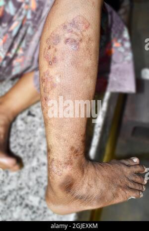 Pilzinfektion genannt Tinea corporis in Bein der asiatischen Frau. Weit verbreiteter Ringwurm über den unteren Extremitäten. Stockfoto