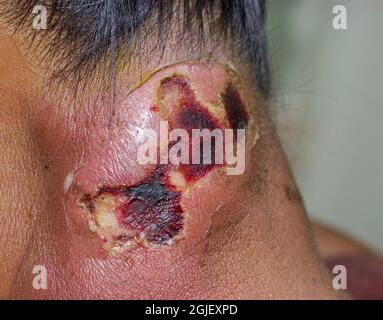 Großer Abszess mit umgebender Cellulitis oder Staphylokokken, Streptokokken-Hautinfektion am Hals einer asiatischen burmesischen Patientin. Stockfoto